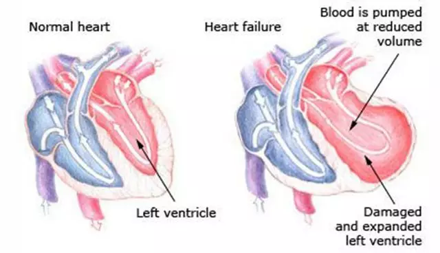 La relation entre l'insuffisance cardiaque chronique et l'anémie